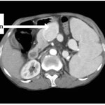 Ct Scan Contrast Consent Form