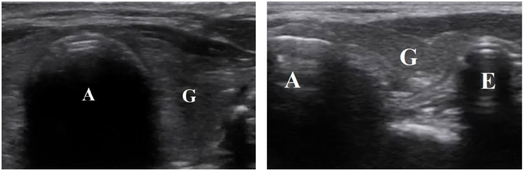 Ultrasound Consent Form