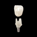 Dental Implant Consent Form Uk