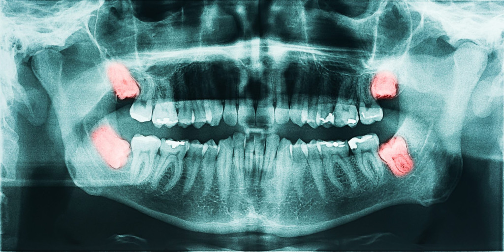 Root Canal Consent Form