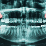 Root Canal Consent Form