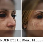 Dermal Filler Consent Form Uk