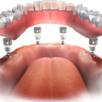 All On 4 Dental Implants Consent Form