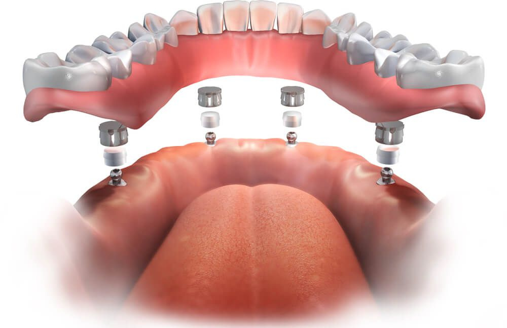 All On 4 Dental Implants Consent Form