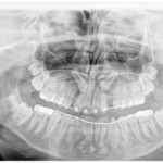 Sinus Lift Consent Form