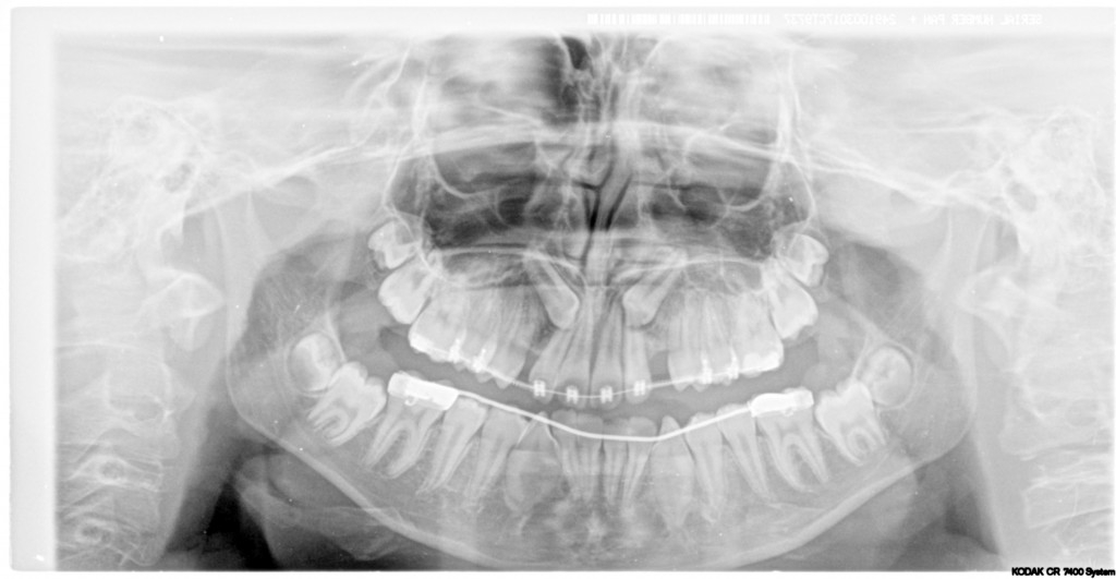 Sinus Lift Consent Form