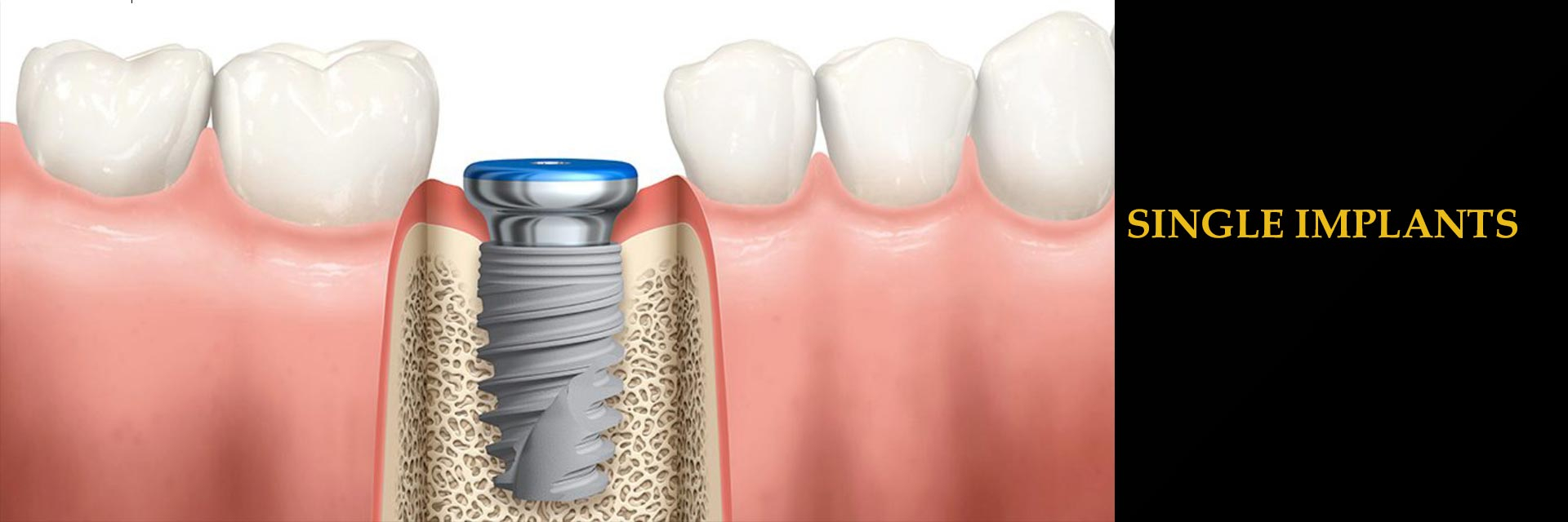 implant crown restoration consent form | Printable Consent Form