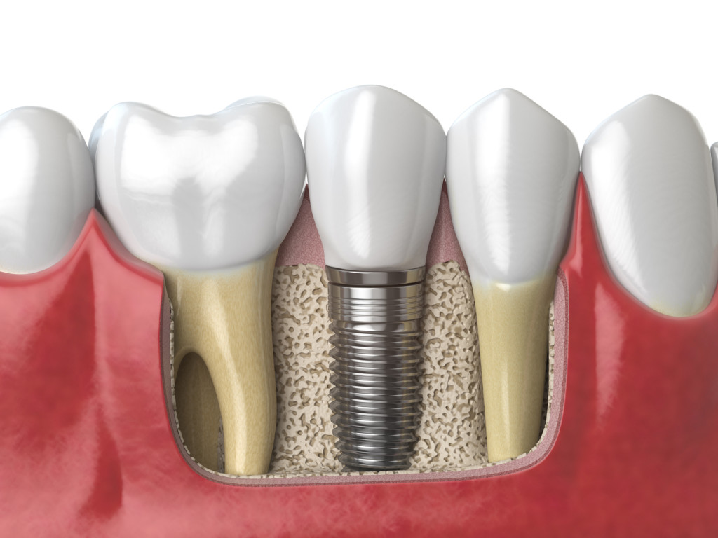 Root Canal Consent Form