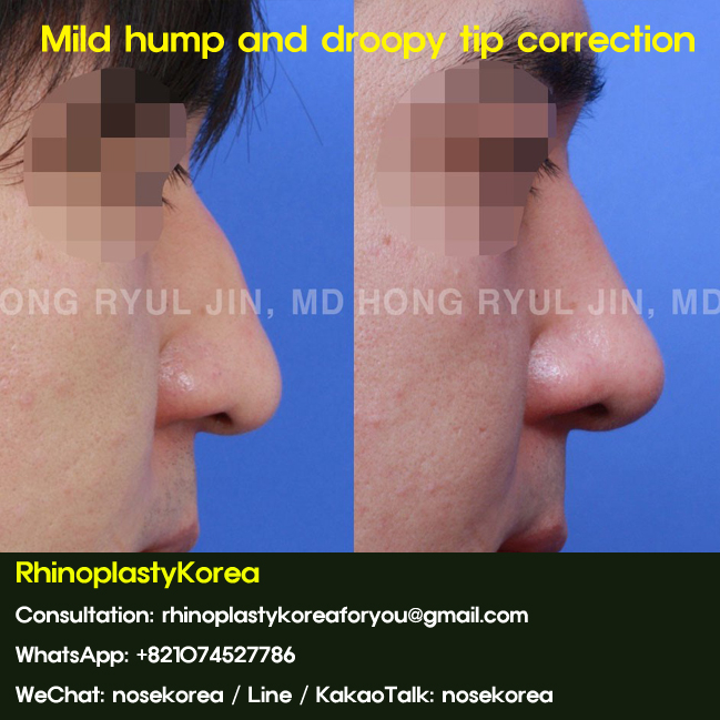 Rhinoplasty Consent Form