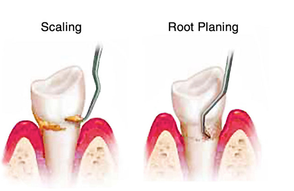 Scaling And Root Planing Consent Form