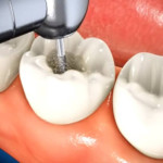 Dental Consent Form For Root Canal Treatment
